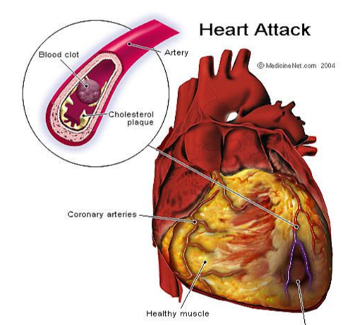 Heart Disease